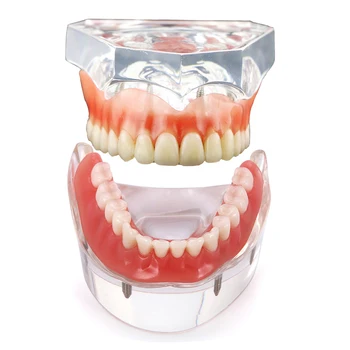 Модел на Зъбите Модел на зъбната протеза с зубным имплантат Модел горната част на долната челюст за демонстрация на общуване с пациента на зъболекаря
